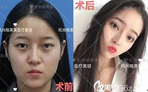 杭州整容爆料案件最新情况,真相逐步浮出水面  第1张